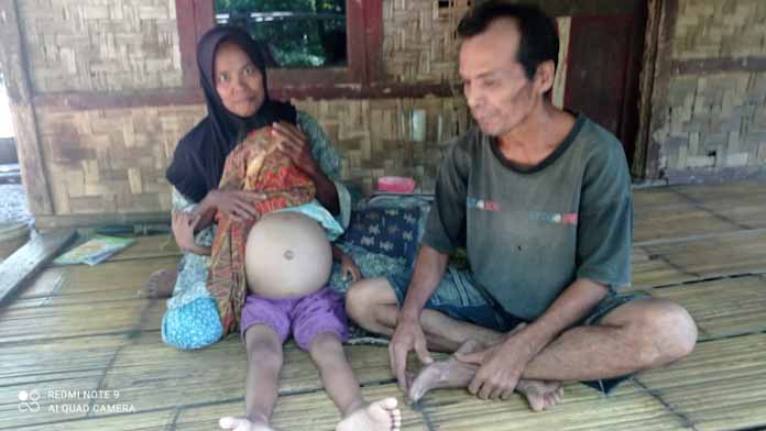 Uniyah 8 th, seorang penderita komplikasi gizi buruk butuh uluran tangan dermawan